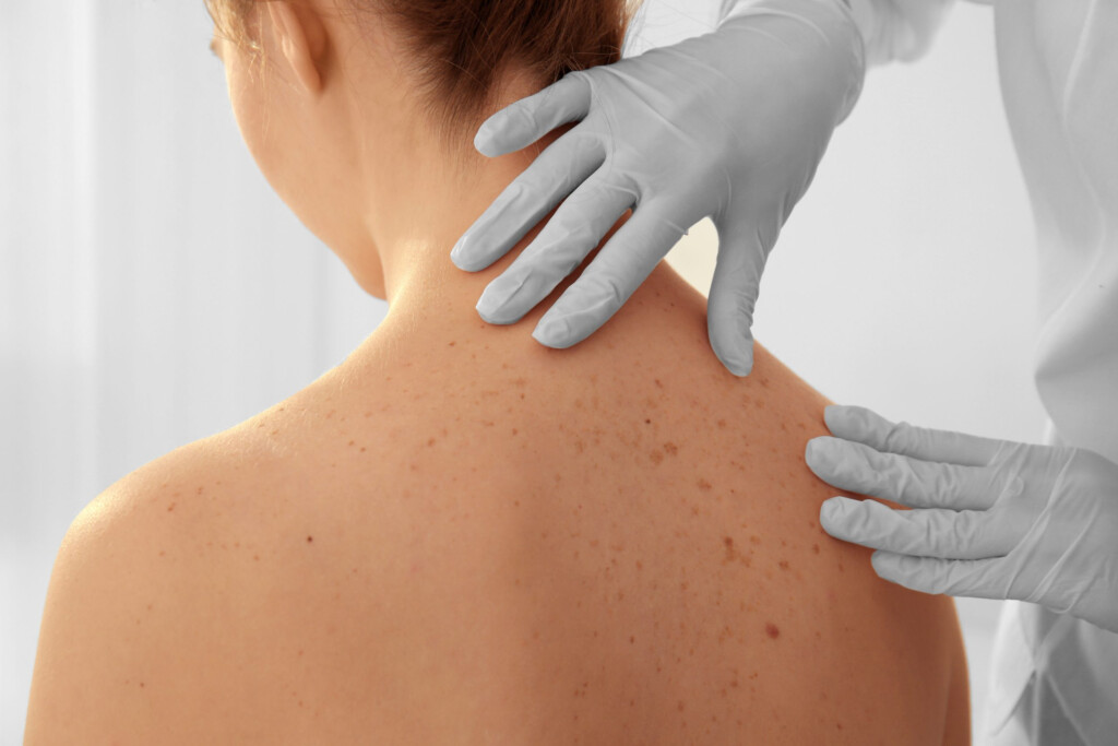 What Does Skin Cancer Look Like Healthcare Associates Of Texas