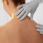 What Does Skin Cancer Look Like Healthcare Associates Of Texas